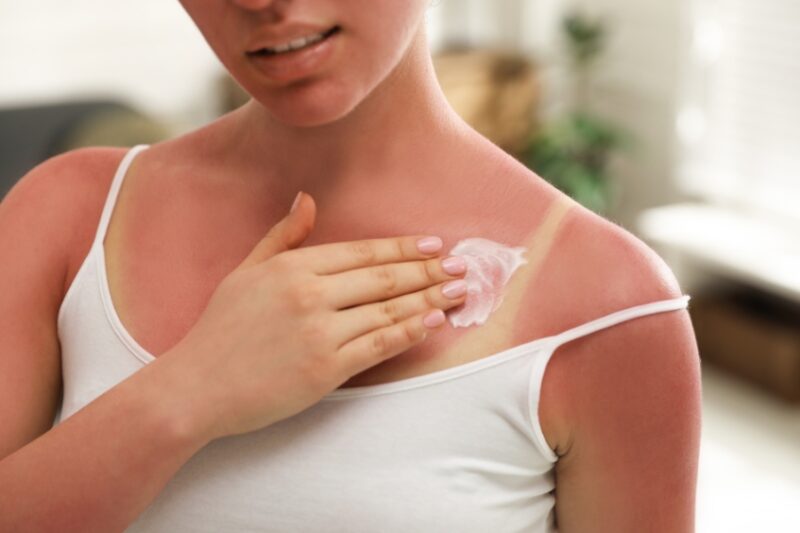 12 Natural Sunburn Remedies That Actually Work